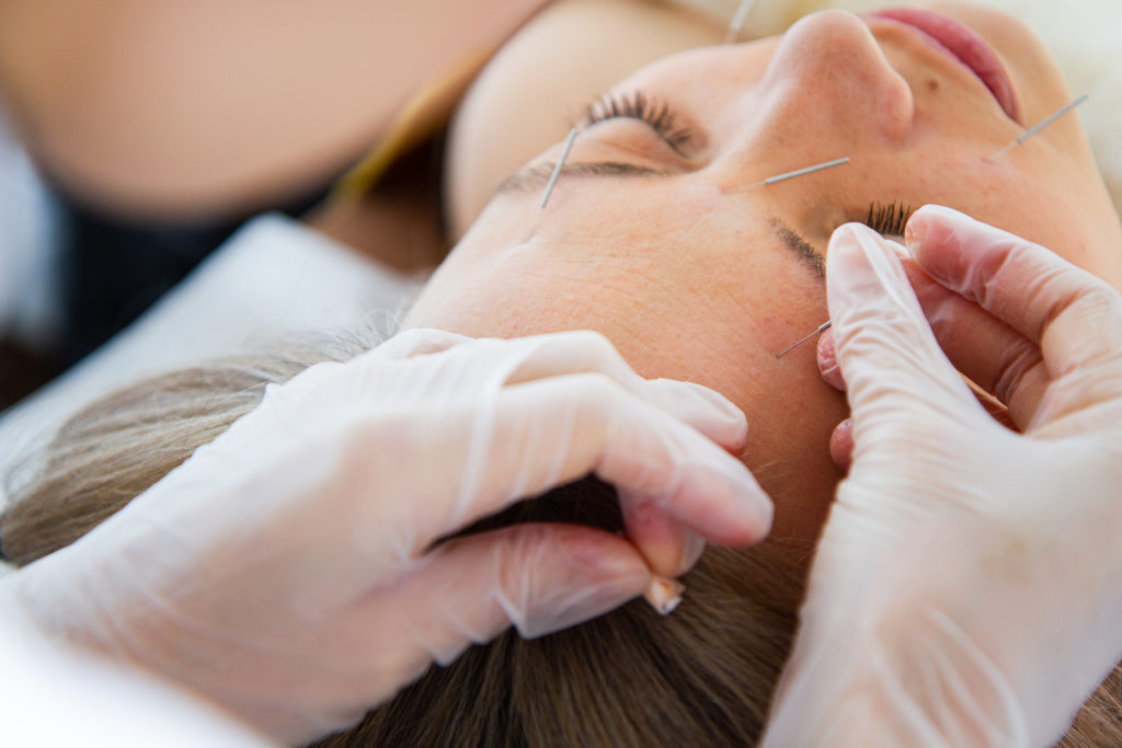 Facial acupuncture - Keypoint Acupuncture